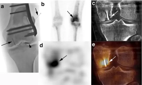 Fig. 4 A 25-year-old man after osteotomy of the left femur and surgical refixation of an osteochondral lesion of the medial femoral condyle 1 year previously