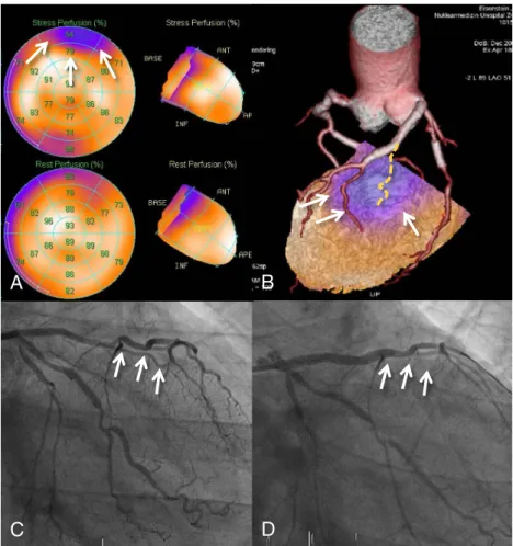 Fig. 4 A 67-year-old patient complained of new-onset chest pain after percutaneous coronary intervention (PCI) of his left anterior descending artery (LAD).