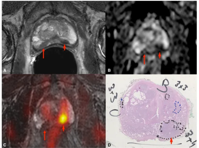 Fig. 2 18 F-Fluorocholine prostate PET/MR imaging in a 71-year-old patient (PSA 6.26 ng/ml, Gleason score 7): a T2-weighted axial image with endorectal coil, b ADC map, c coregistered image from the MR 3-D T2-weighted axial and colour-coded PET acquisition