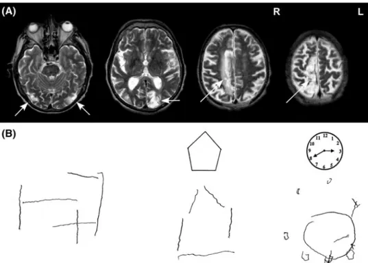 Fig.  1   a t2-weighted MRI scan  performed 9 months post-injury  showing ischemic damage to  bilateral occipito-temporal  cor-tex (left), left medial  occipito-parietal cortex (middle) and  dor-sal frontoparietal cortex (right)