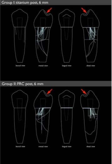 Fig. 3 Detailed failure report of each experimental group summarising all of the main fractures and additional cracks in the dentine (direction of the applied force in the load-to-fracture test denoted by red arrows) Table 1 Distribution of the fracture pa