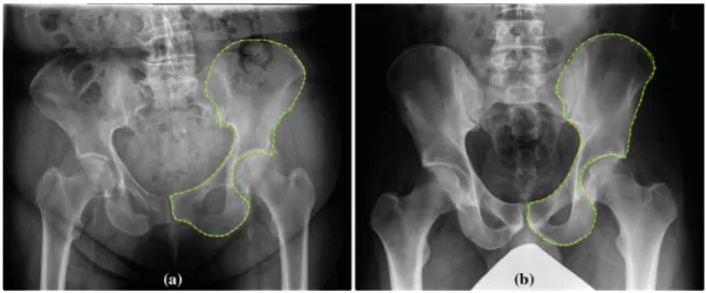 Fig. 10 Preliminary results of segmenting the left hemi-pelvis with the presented algorithm (ground truth: green curve; result: yellow dots and contour): a mean error 0.58 mm; b mean error 1.25 mm
