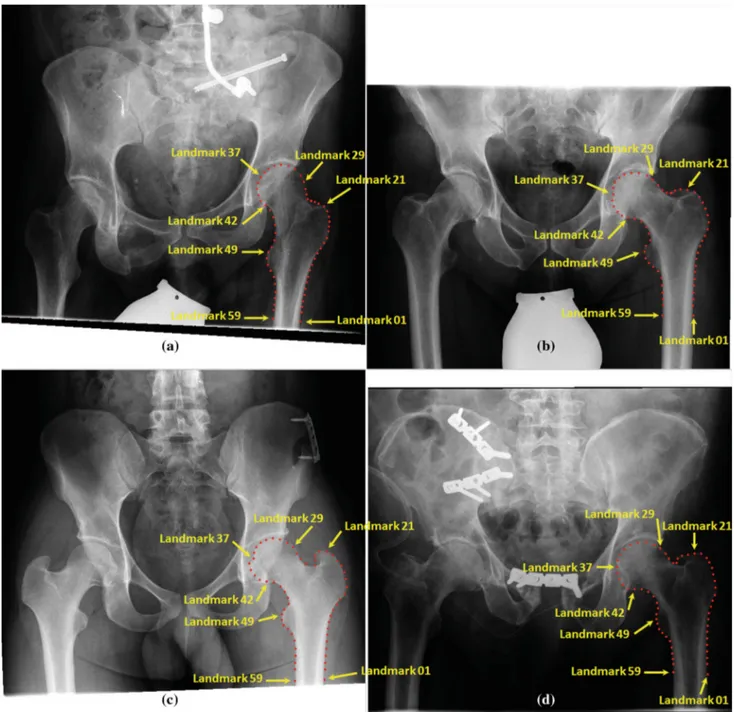 Fig. 2 Examples of the landmark-based annotation of the left proximal femur in the training radiographs g i = 1 67 67 j = 1 g ij (2)