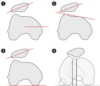 figure shows the measurement of the lateral patellofemoral angle according to Laurin. The lateral patellofemoral angle is formed by the lines A–A and B–