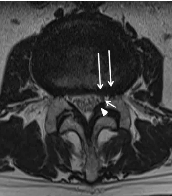 Fig. 2 Lateral stenosis. Axial T2 weighted MR image of the L4/L5 lower lumbar segment of a 67 years-old patient with left-sided accented lateral recess narrowing