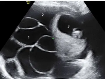 Abb. 1  9  Massives,  spontan  aufgetre-tenes  Überstimulati-onssyndrom bei einer  Einlingsgravidität mit  vergrößerten Ovarien  (1), Aszites (2) und  ei-ner intakten  Schwan-gerschaft (3) in der 11