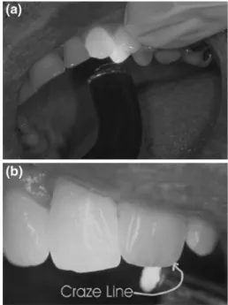 Fig. 1 a, b Detection of enamel craze line or cracks using a blue light transillumination, b inspection light