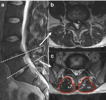 Fig. 1 MRI of the lumbar spine with a recessal disc herniation at L4/L5.