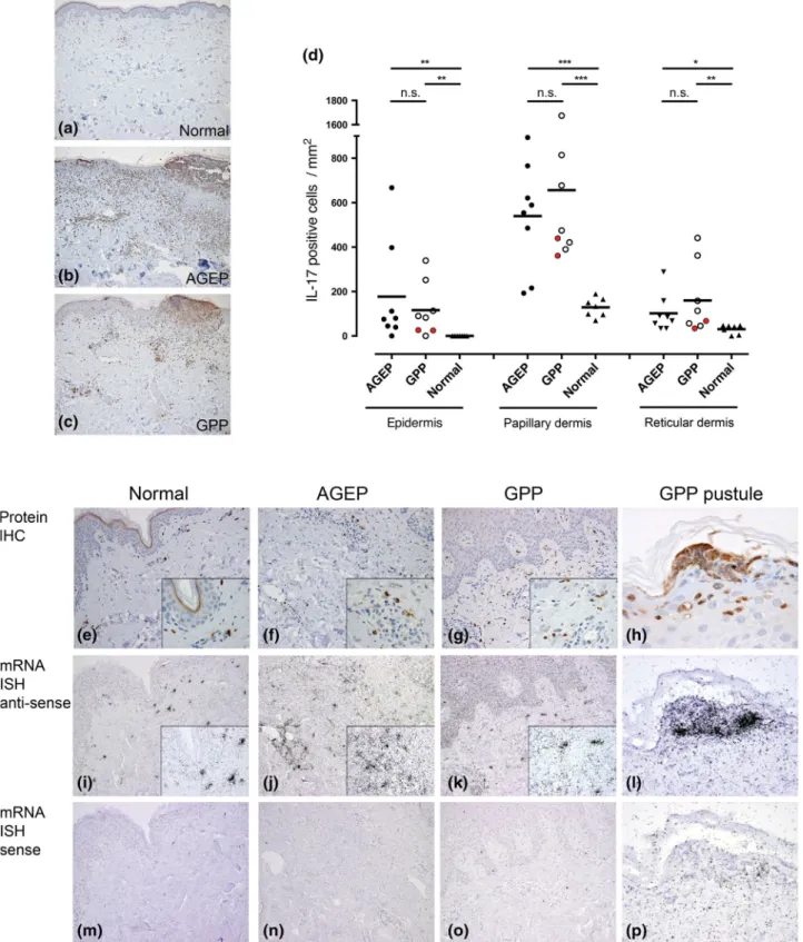 Fig. 1 IL-17A/F expression in normal skin, AGEP, and GPP.