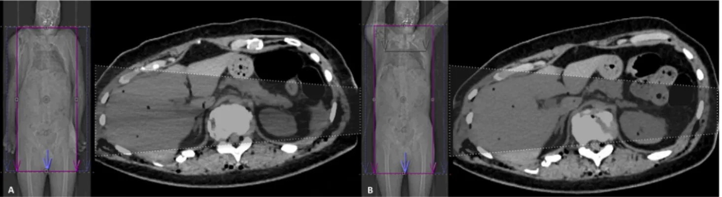 Fig. 6 a Omitting elevation of the arms with typical beam hardening and scatter, producing dark streaks (streak artifacts, indicated by the highlighted trapezoid) between two high attenuation objects (in this case, the bones of the lowered arms)