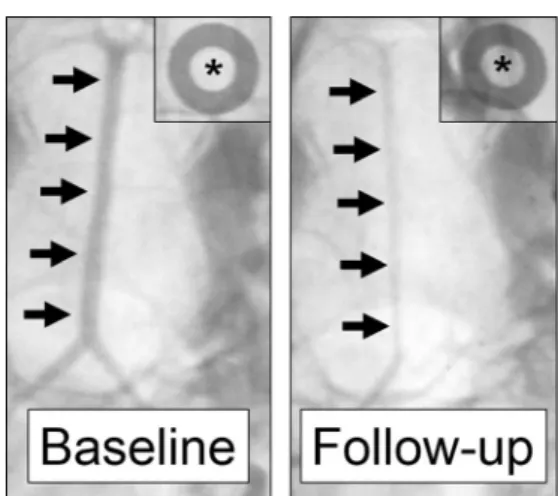 Fig. 3 Digital subtraction angiography. Digital subtraction angiography of the basilar artery (black arrows) is performed by retrograde  intra-arterial bolus injection of nonionic Iopamidol (0.6 ml/kg, for 1 to 2 s) through the left (baseline) and right (f