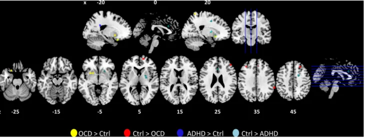 Fig. 1 The centres of the clusters that showed differences in grey matter volumes of patients with ADHD or OCD in five recent  meta-analyses (Ellison-Wright et al