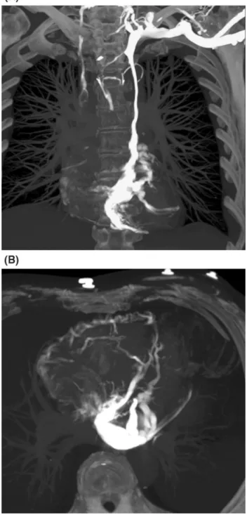 Fig. 2 CT phlebography. A Thin-slab reconstruction using the maximum intensity projection algorithm in the coronal view showing occlusion of the IV and patent left superior vena cava connected to the coronary sinus, which is connected to right atrium