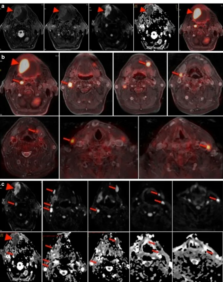 Fig. 2 a – c Sixty-nine-year-old man with squamous cell carcinoma of the base of the tongue
