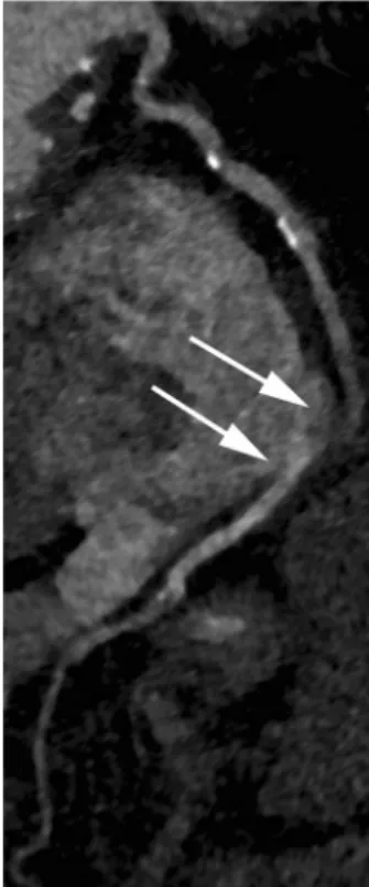 Fig. 4 70-year-old man with an average HR of 76 bpm and a HRV of 7 bpm undergoing CT for follow-up of conservatively treated aortic aneurysm