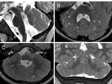 Fig. 2 Axial (a ) and midsagittal (b) T2-weighted MR images of patient 3 at the age of 1.8 years show multiple cortical/subcortical cysts located within the cerebellar vermis (mostly anterior and superior part) and both cerebellar hemispheres (mostly poste