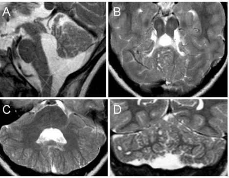 Fig. 4 Midsagittal (a ), coronal (b ), and axial (c, d) T2-weighted MR images of patient 6 at the age of 4.3 years show multiple cortical/subcortical cysts located within the cerebellar vermis (mostly posterior and superior part) and both (right more than 