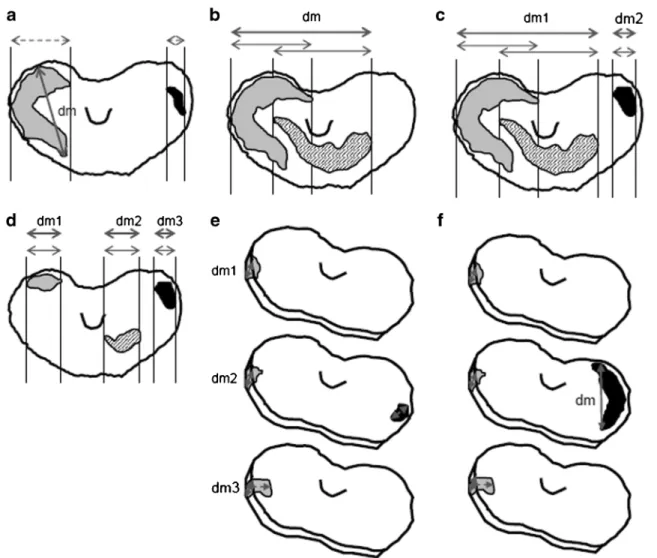 Fig. 1 Largest diameter (dm) measured in the horizontal and vertical planes. a Largest dm in the horizontal plane including two  non-overlap-ping tumors
