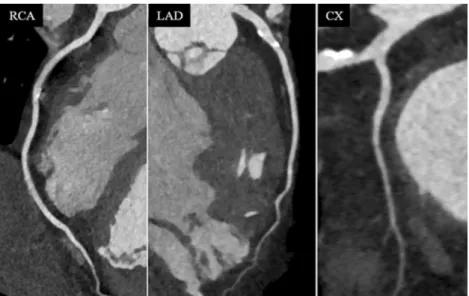 Fig. 5 CCTA in a 50-year-old patient with a heart rate of 78 bpm. Image quality was excellent to good (score 1 and 2) in all segments of the LAD and LCX, while image quality was non-diagnostic (score 4) for segment 2 of the RCA due to blurring artefacts (a