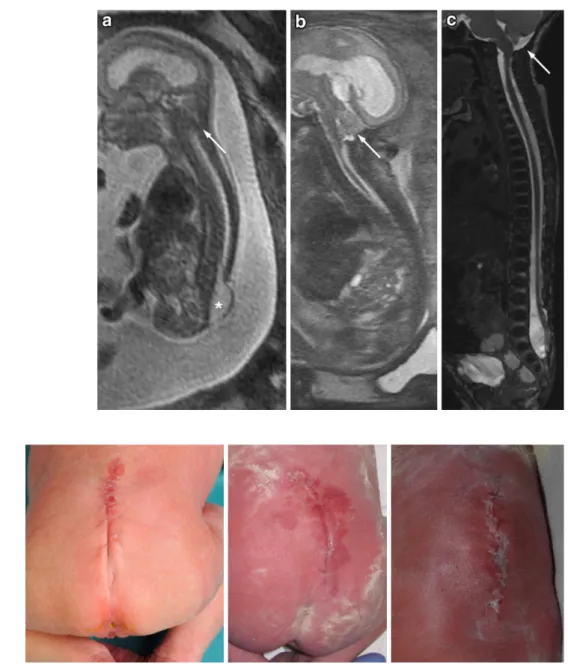 Fig. 4 Three typical aspects (own cases) of repair sites on the first day of life. A perfectly healed skin, no cerebrospinal fluid leak, and a suture that is still in place is what we observe on a regular basis