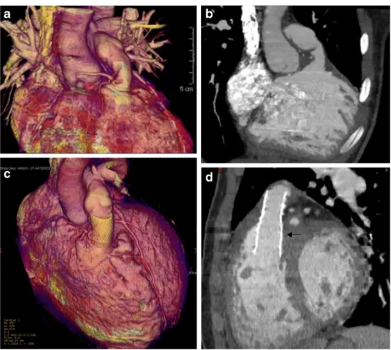 Fig. 7 Endocarditis with mediastinitis in patient 17. a Contrast-enhanced CT with sagittal MIP view shows the thickened valve leaflets (arrow)