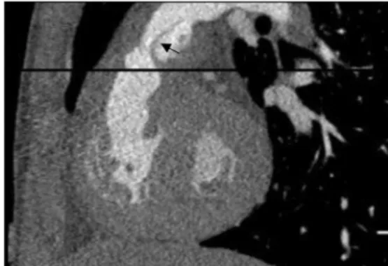Fig. 8 Endocarditis in patient 19. Cardiac-gated CT, sagittal view, shows a hypodense membrane inside the Contegra® (arrow)