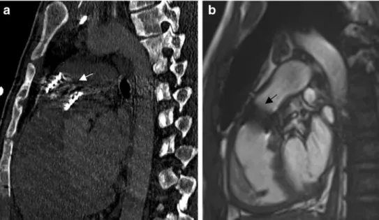 Fig. 9 Two different patients with a valve inserted inside the Contegra®. a CT with sagittal view shows a Sapien® valve (arrow) implanted in a previously stenosed Contegra® in patient 10.
