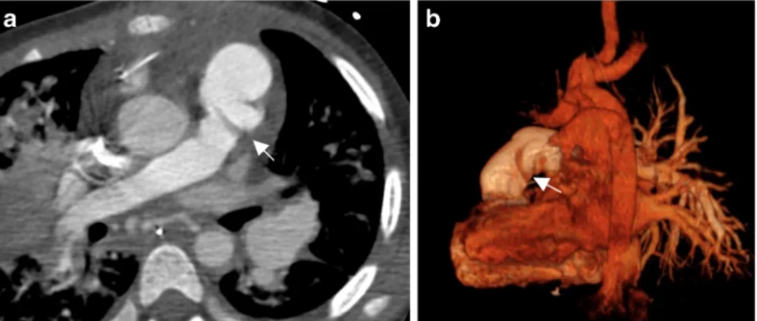 Fig. 5 A twisted Contegra® in a patient with a hypoplastic left pulmonary artery in patient 12