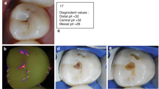 Fig. 4 Patient of 28 years old. a Clinical view before treatment. b VistaProof image. c DIAGNOdent values