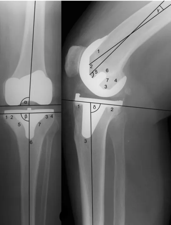 Fig. 1 Anterior–posterior (AP) and lateral radiographs four months postoperatively of a 72-year-old patient; angles α , β , γ , δ and femoral and tibial radiolucency zones according to the Knee Society radiographic evaluation and scoring system