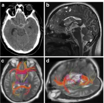 Fig. 1 Axial view of cerebral CT scan showing a subarachnoid hemor- hemor-rhage Fisher IV from a ruptured DACA aneurysm (a)