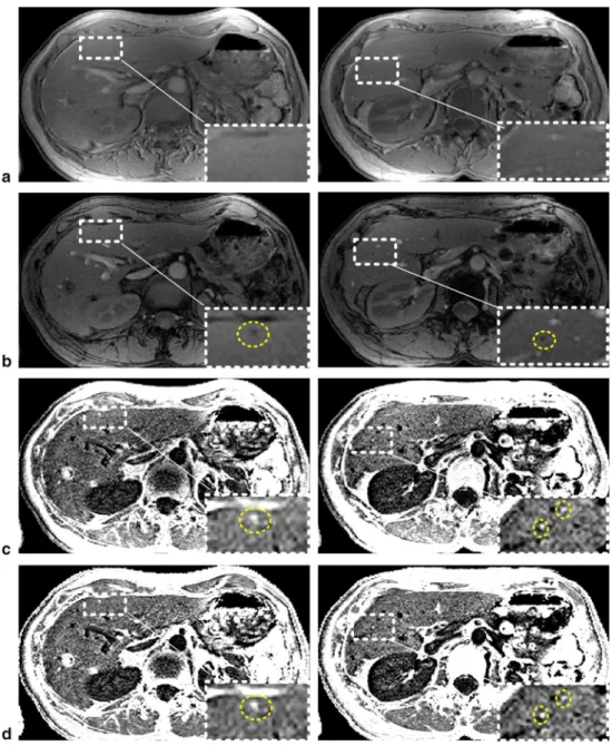 Fig. 3 MR images (1.3 9 1.3 9 2.5 mm 3 , acquisition time 19 s) acquired at two different slice positions (left and right) at 3T with a variable TE 3D SPGR sequences from a patient, who had undergone transplantation of labeled pancreatic islets: a sub-mill