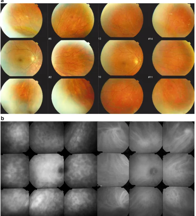 Fig. 2 Patient 2, a female who was 54 years old at diagnosis, with a diagnostic delay of 9 months and a treatment delay of 10 months (right eye)