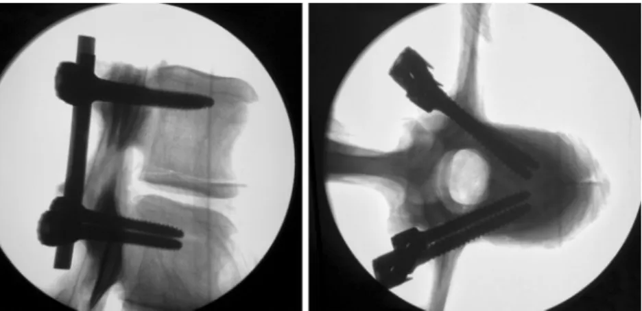 Fig. 1 Fluoroscopic lateral and axial images of a vertebral segment, instrumented with the standard sagittal parallel screw technique