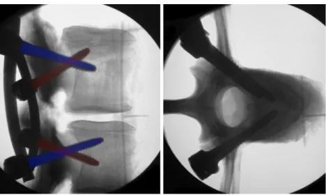 Fig. 3 Posterior view of instrumented vertebral segments with the standard sagittal parallel screw and the alternative sagittal non-parallel screw technique