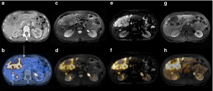Fig. 4 A 57-year-old patient with liver metastases due to rectal cancer. a , b Hepatic metastasis with abnormal FDG uptake is clearly seen in segment II on both the PET/MR image with T2-weighting (a arrow) and the PET/CT image after contrast material admin