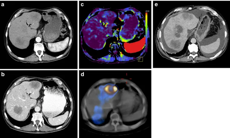 Fig. 4 A 73-year-old male patient with metastases from colorectal cancer in both liver lobes