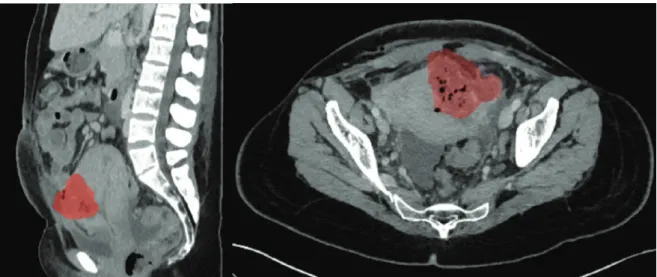 Figure 1: Contrast-enhanced CT obtained on post-cesarean day 10 demonstrates fluid collection with gas formation in the anterior myome- myome-trium (red), suggesting uterine incisional necrosis and abscess-formation: (Left) transvers sectional plane