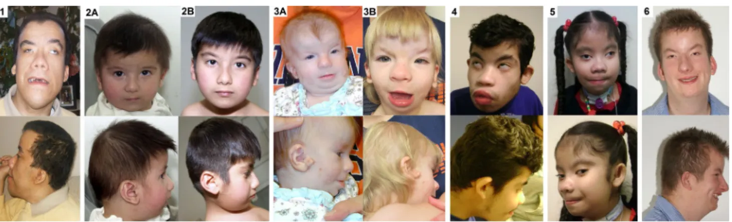 Fig. 1   Facial features of the individuals described in this study. the numbers correspond to the numbers in table 1