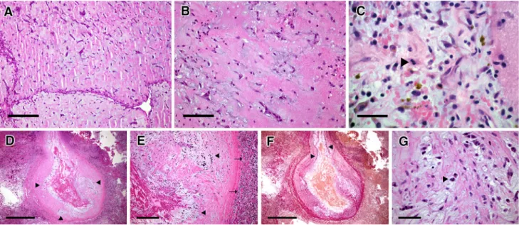 Fig. 1 Histological analysis of cardiac tumor and cerebral aneurysms a The papillary aortic tumor is dominated by a paucicellular myxoid background