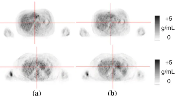 Fig. 9 Non-TOF/PSF axial PET images for two patient cases: P004 (top row) and P011 without a and with b AA coil