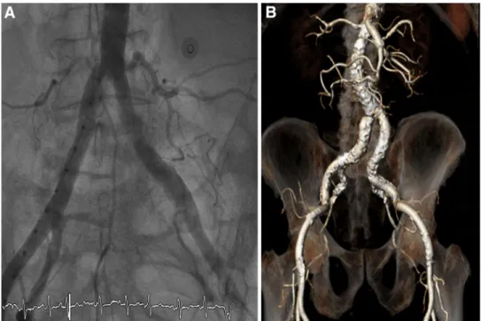 Fig. 2 Imaging of the femoral arteries using contrast angiography (a) and  three-dimensional reconstruction using multidetector computed tomography (MDCT) (b).