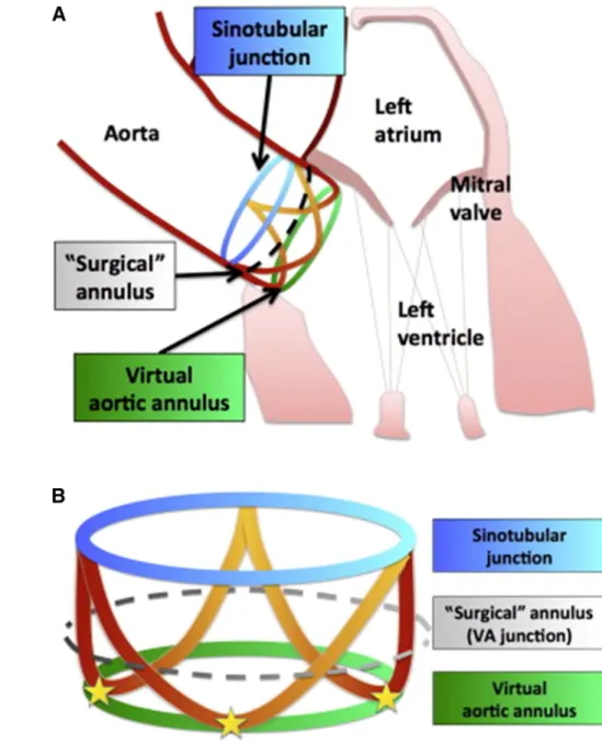 Fig. 4 The aortic annulus used for the purposes of aortic prosthesis sizing concerns a virtual ring formed by the basal attachments of the aortic valve cusps located at the base of the crown
