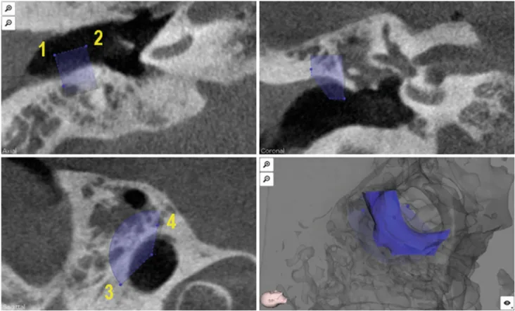 Fig. 5 External auditory canal wall segmentation using 4 points and a defined threshold