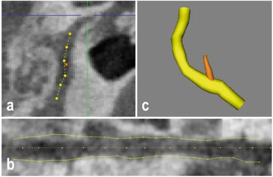 Fig. 6 Interactive drawing of the facial nerve and chorda tympani centrelines (a). Curved planar reconstruction (CPR) along the facial nerve’s centreline (b)