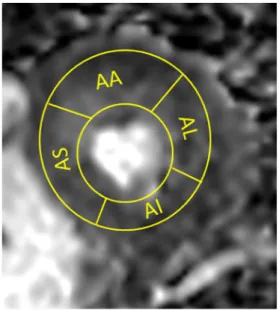 Fig. 1 Schematic demonstration of region of interest (ROI) placement in the left ventricle according to American Heart Association segmentation model, demonstrating four segments in short axis apical slice on  fraction-al anisotropy map