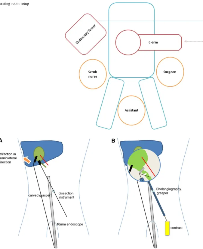 Fig. 2 Schematic view of the surgical procedure. A Retraction and dissection of Calot’s triangle