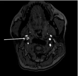 Figure 3: MRI (axial image) showing complete resolution of the  stenosis and a small residual intramural haematoma around the  area of the dissection.