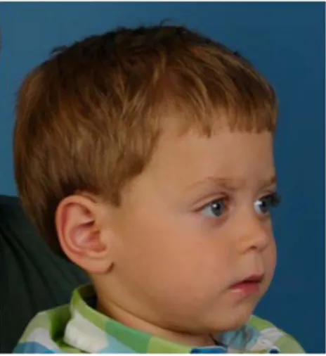 Fig. 5 Orbital region of a patient after correction of trigonocephaly;