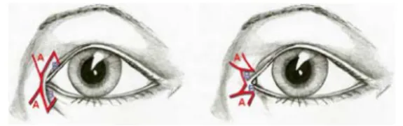 Fig. 9 Clinical picture before epicanthus correction